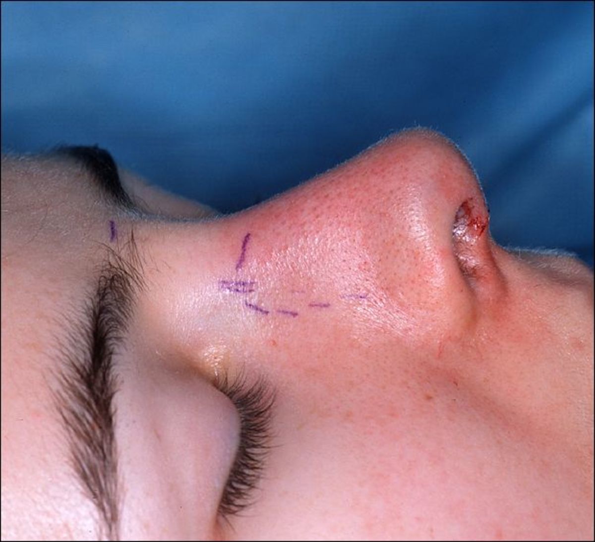 Post-operative photo of rhinoplasty. The marks guided the surgeon where to cut into bone.