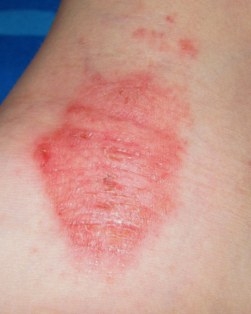 eczema-symptoms-causes-and-treatment