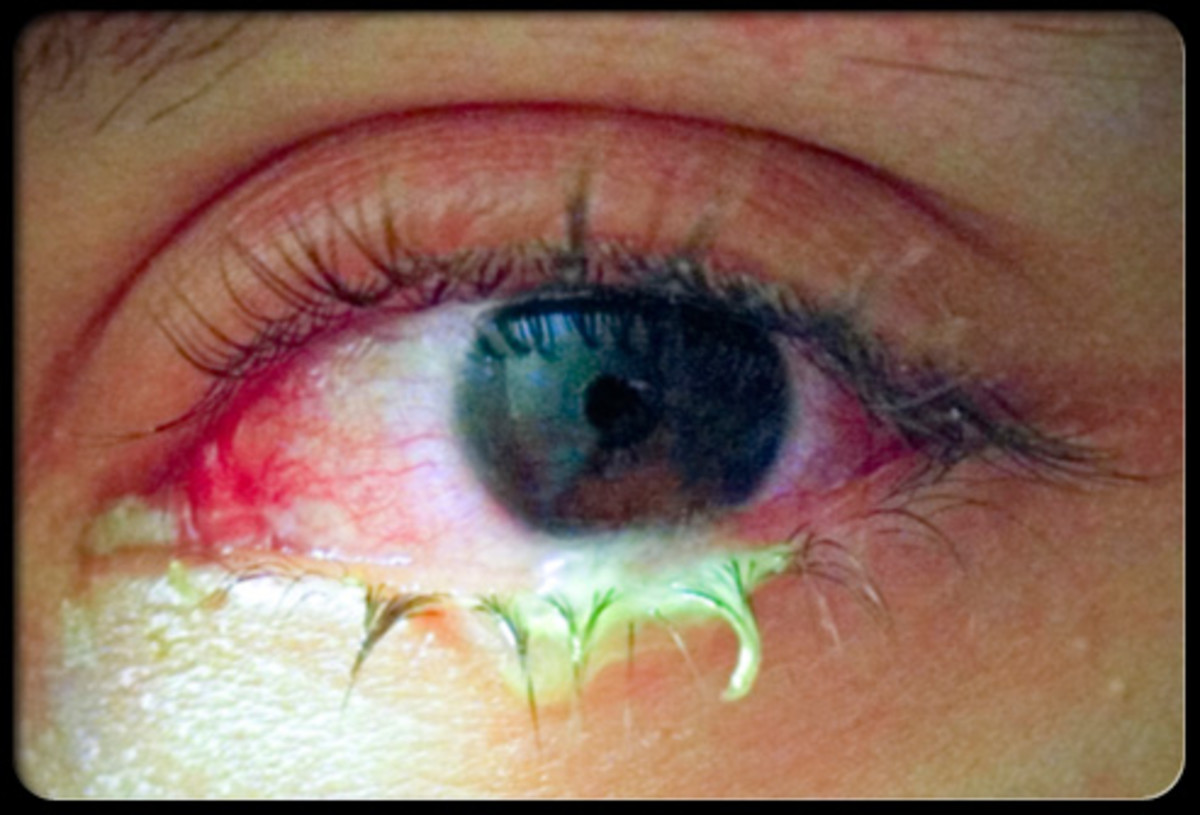 5-natural-remedies-for-pink-eye