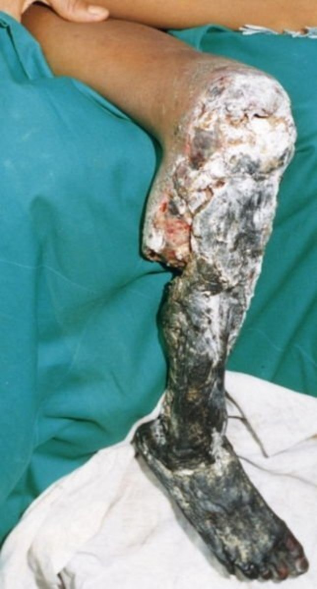 Extensive Necrosis After Snake Bite
