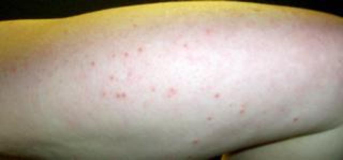 How to Get Rid of Bumps on Arms - HubPages