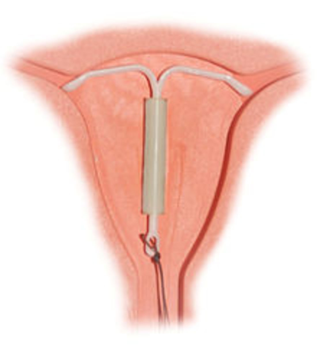 Hormonal IUD 