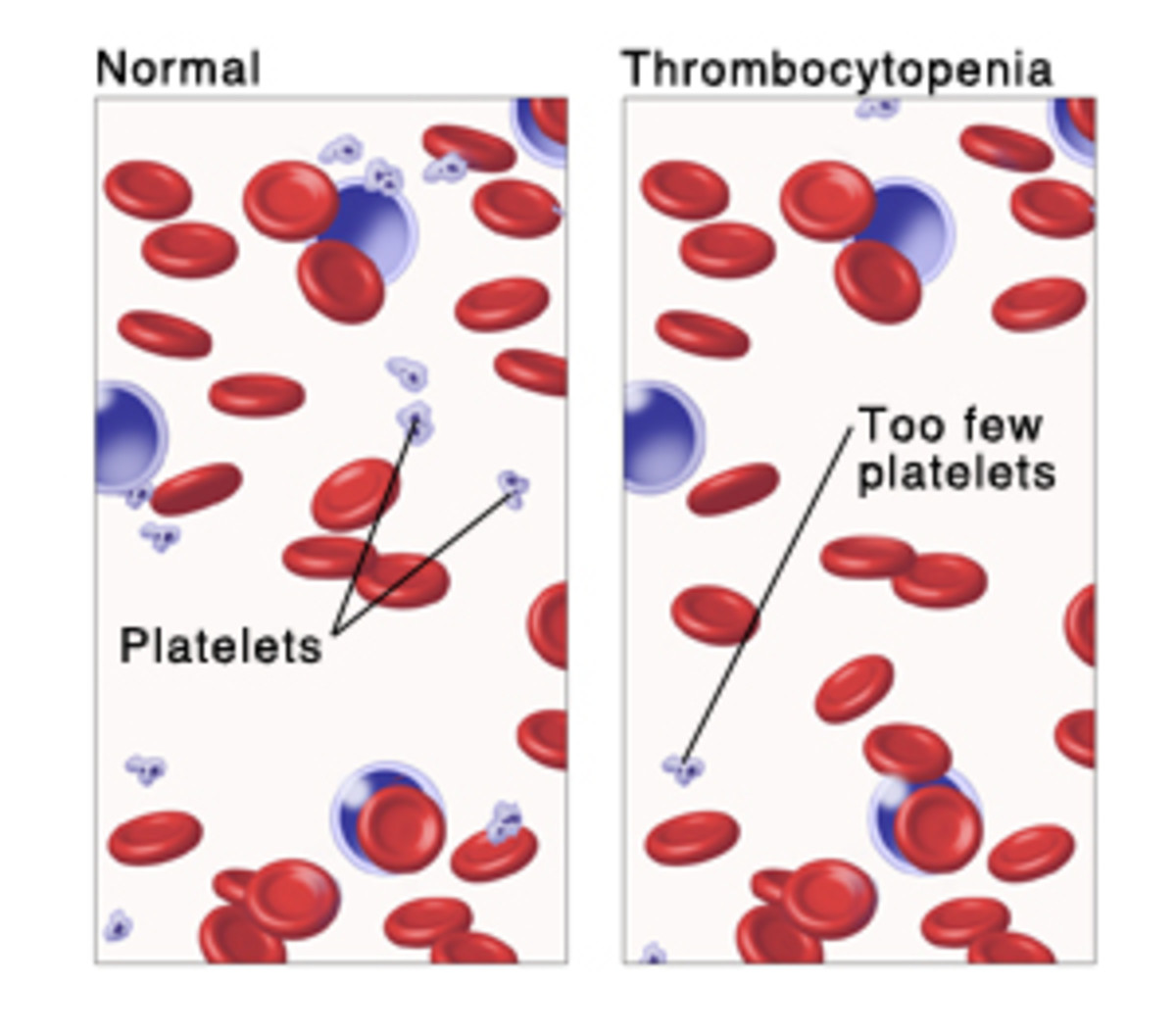 There are fewer platelets in the blood of a patient with I. T. P