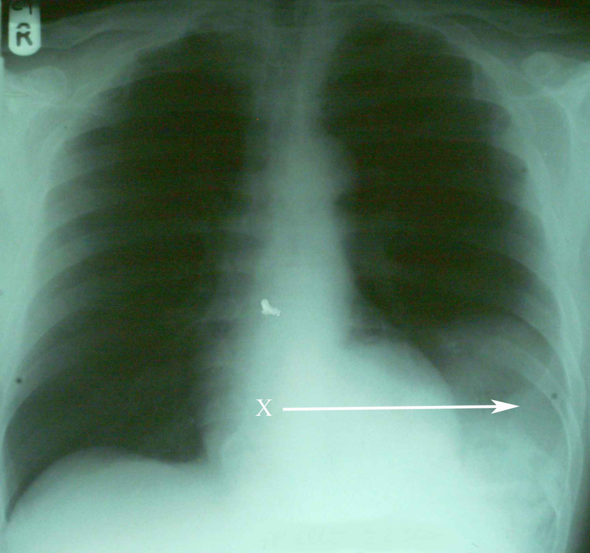 An X and an arrow marks the position of the spleen in the chest cavity