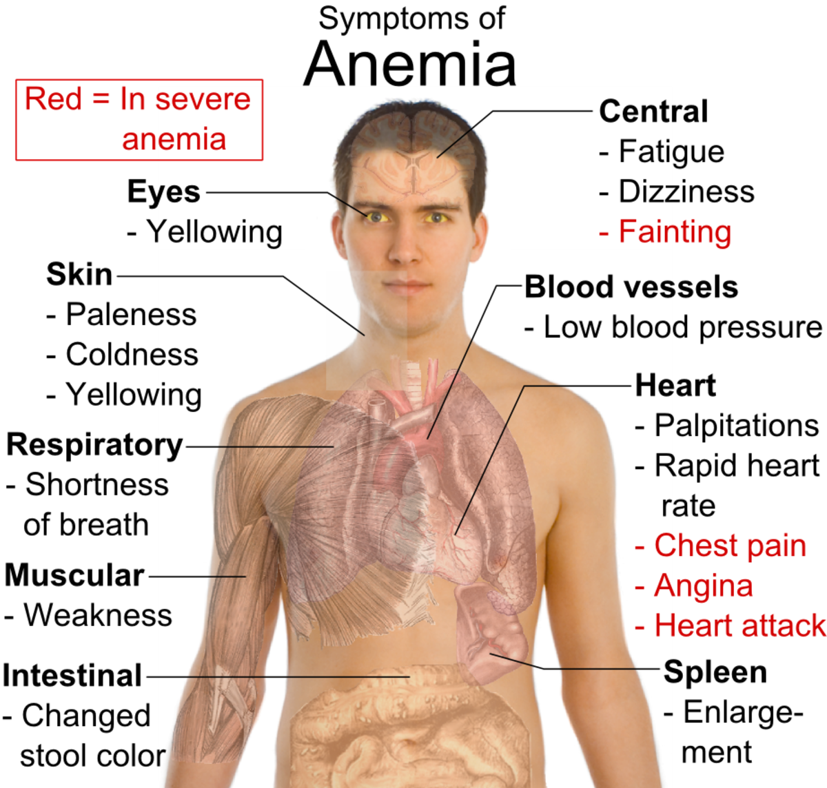 irony-of-anemic-condition-easy-anemia-home-remedy-hubpages