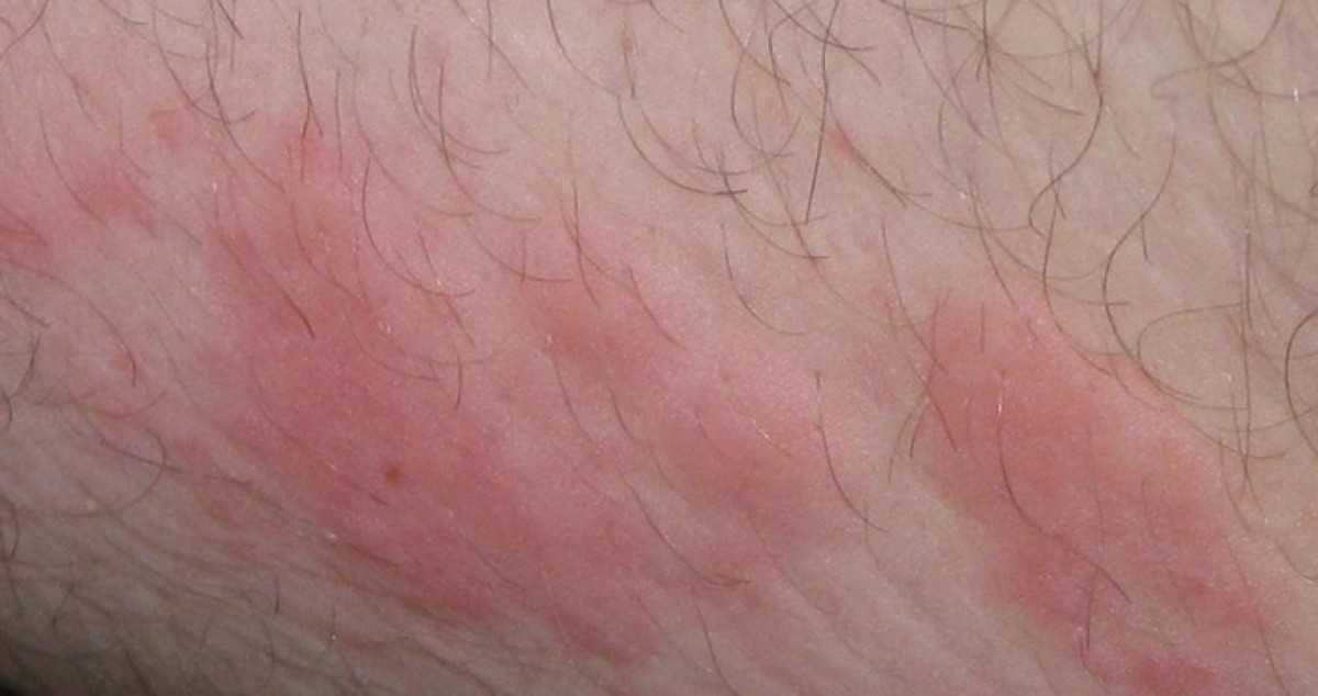 Stress Rash Causes Symptoms And Treatment YouMeMindBody