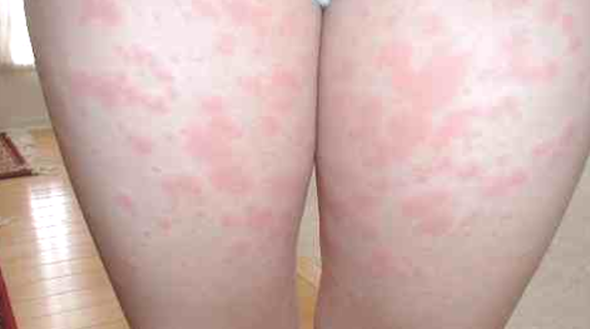 Lamictal rash – Symptoms, Treatment, Images
