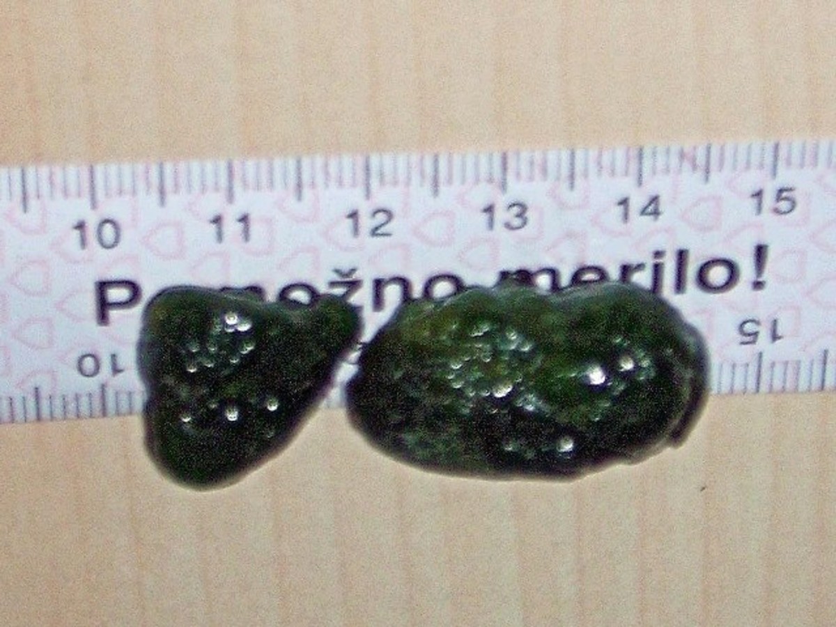 Pigment stones
