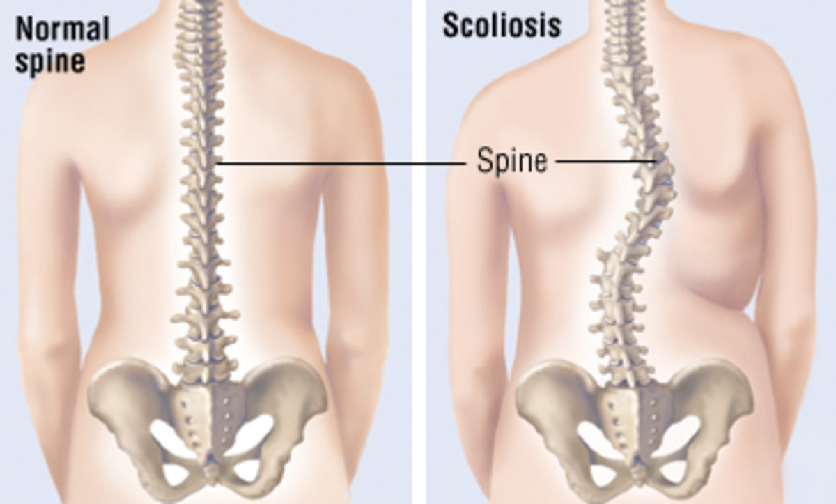 scoliosis-and-dancers
