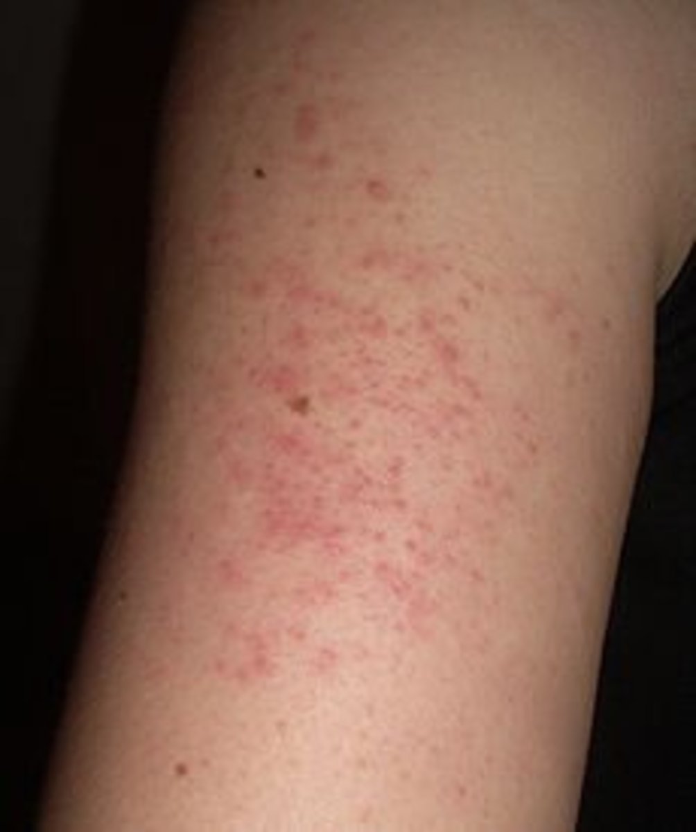 Keratosis Pilaris is easily identified by a dermatologist but more difficult to treat. 