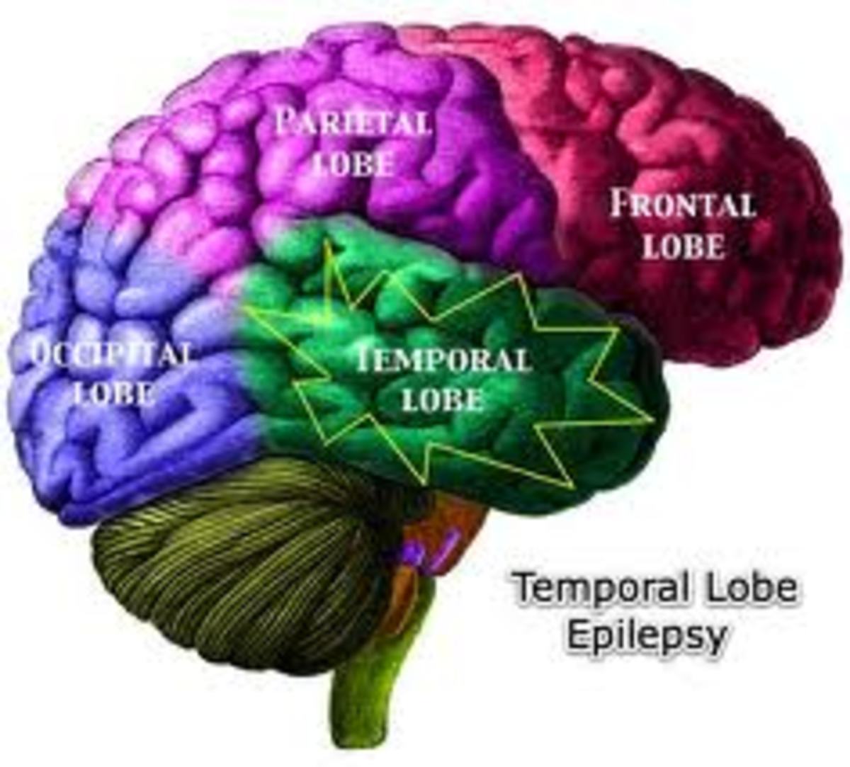 Living with simple and complex partial seizures of the temporal lobe