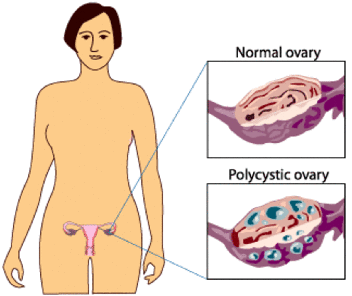 what-is-polycystic-ovary-syndrome-pcos