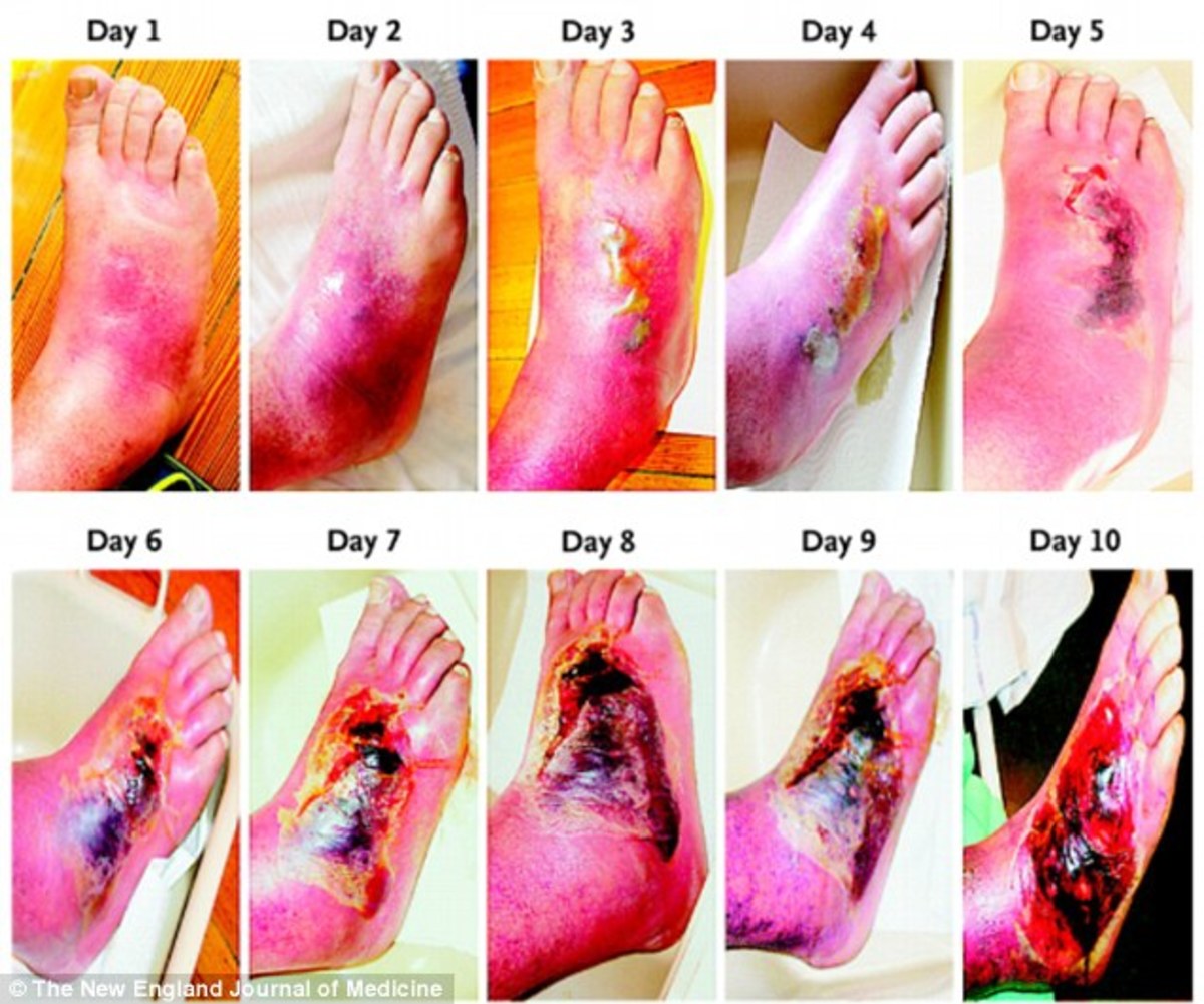 Diabetic Foot Ulcers And The Use Of low Level Laser Therapy(LLLT)  or Photobiomodulation