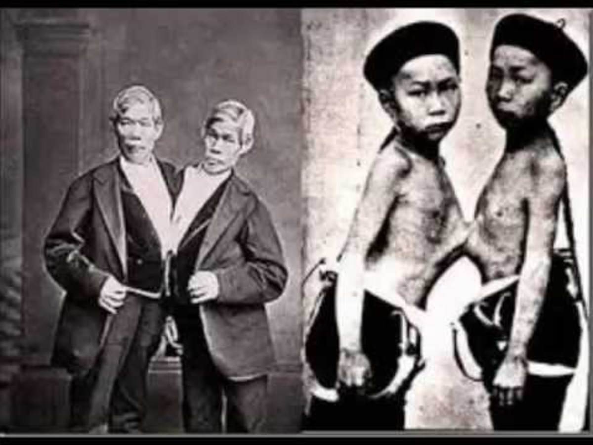 10-congenital-twins-from-history-you-know-nothing-about