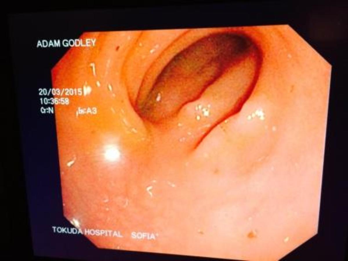 Pillcam image of my son's diseased terminal ileum. 