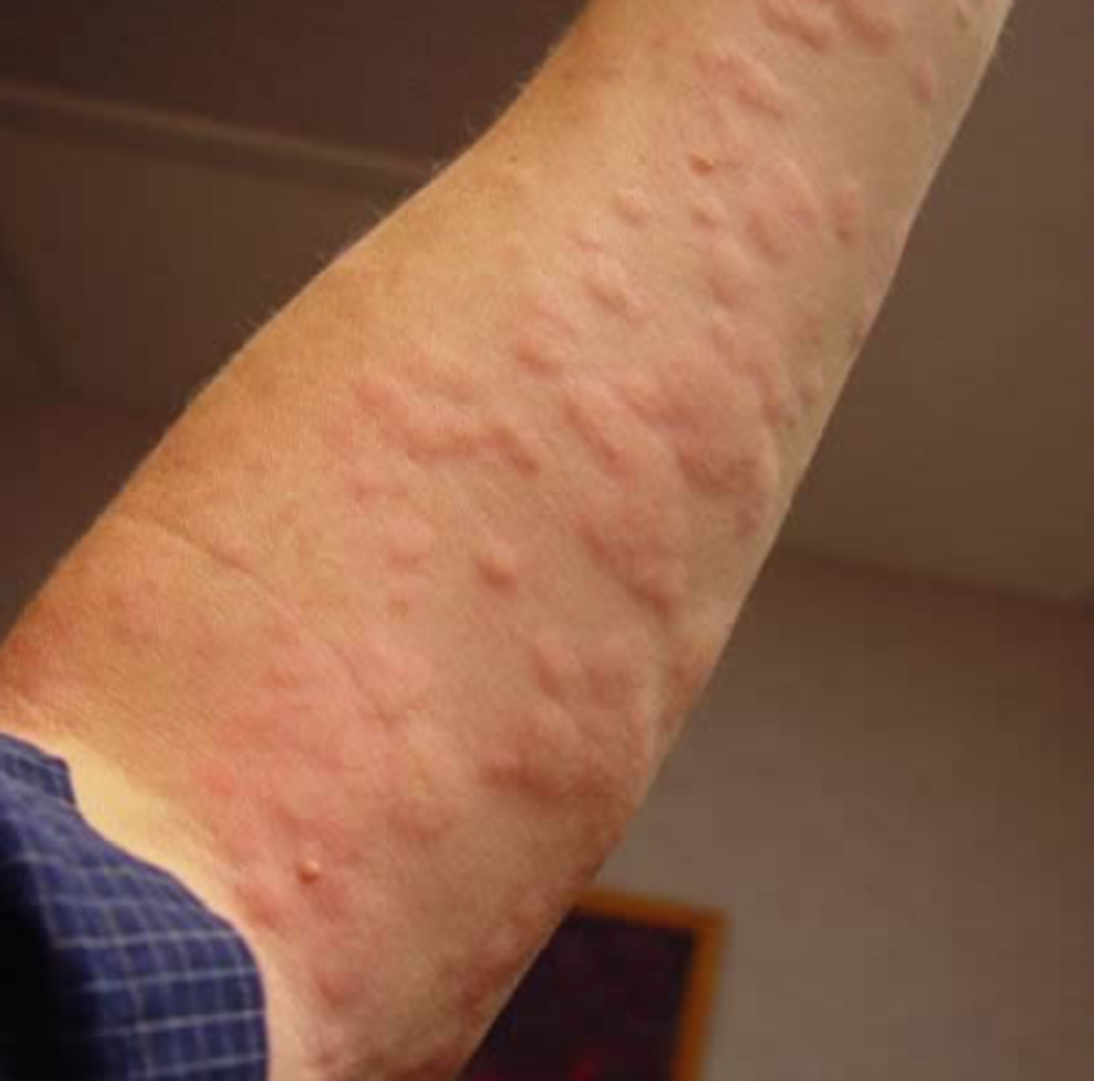 (Urticaria) Relief from Hives and Eczema Rashes In Under One Minute, Naturally