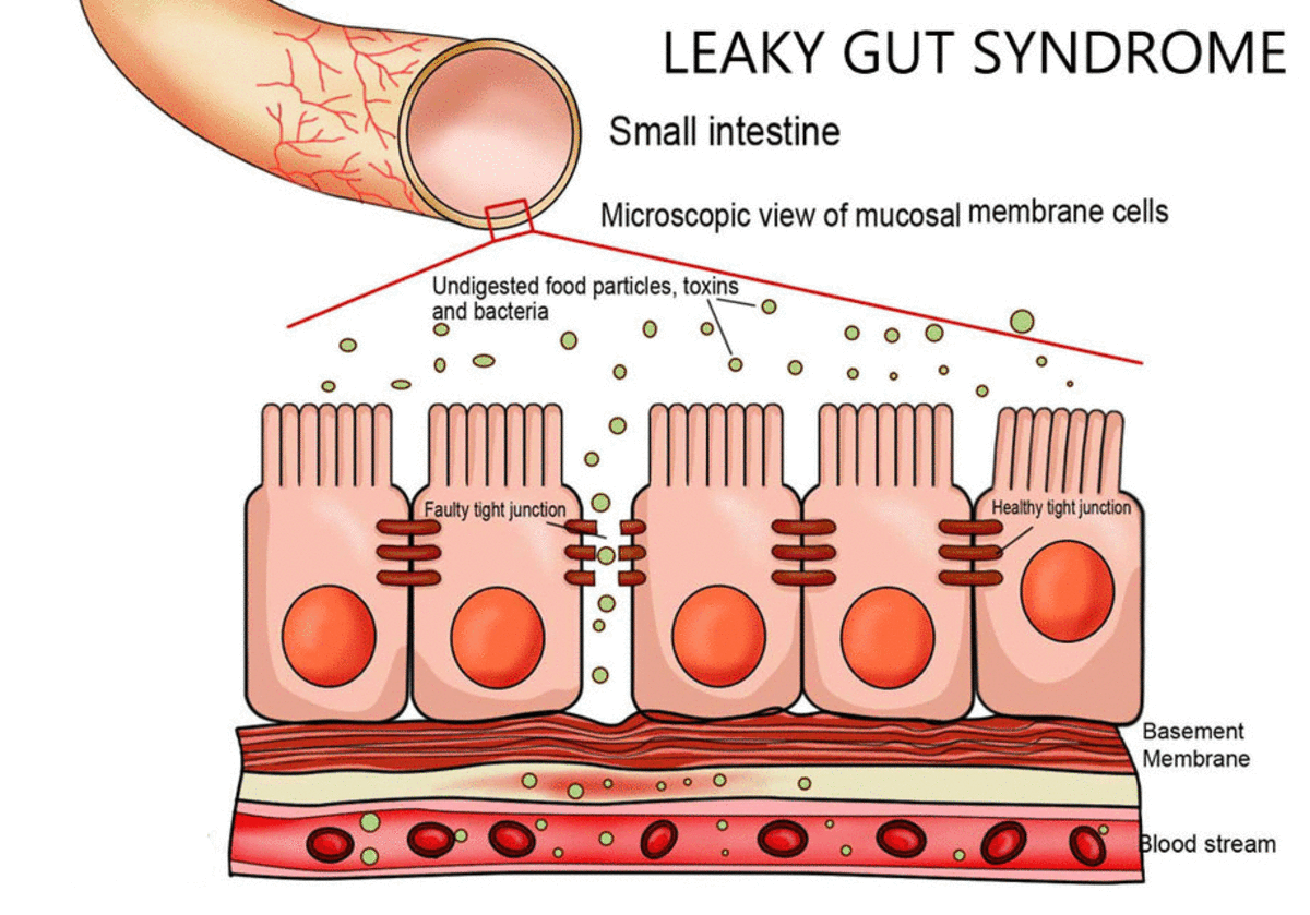 All That Is Leaky Gut