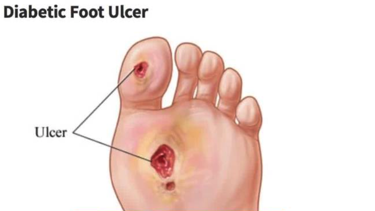 Diabetic Foot Ulcer and Treatment.