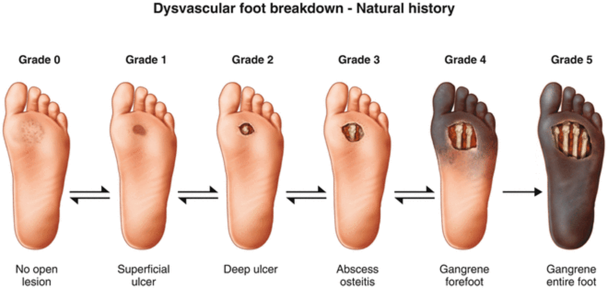 Diabetic Foot Ulcer Amputation