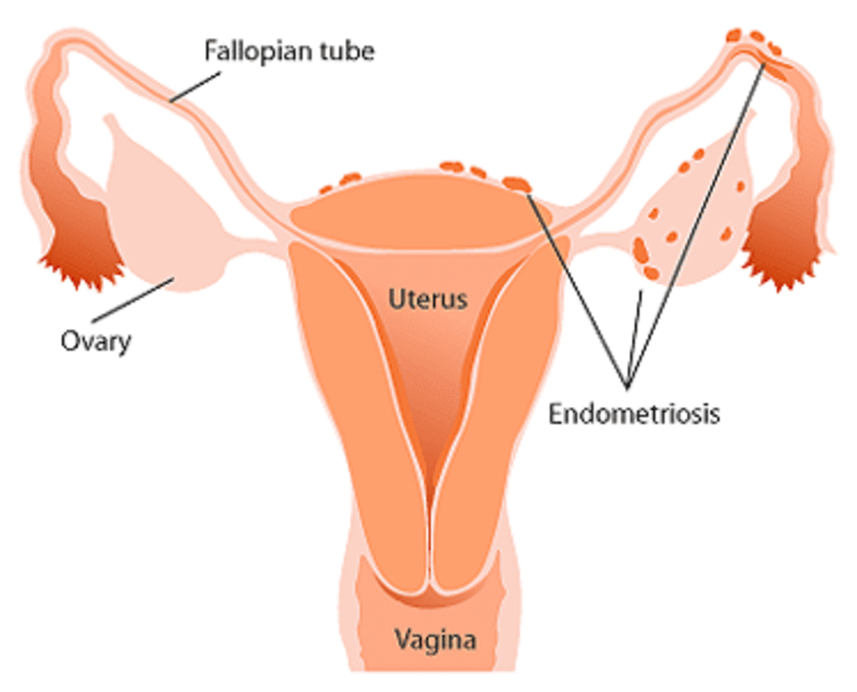 endometriosis-diet-for-pain-relief