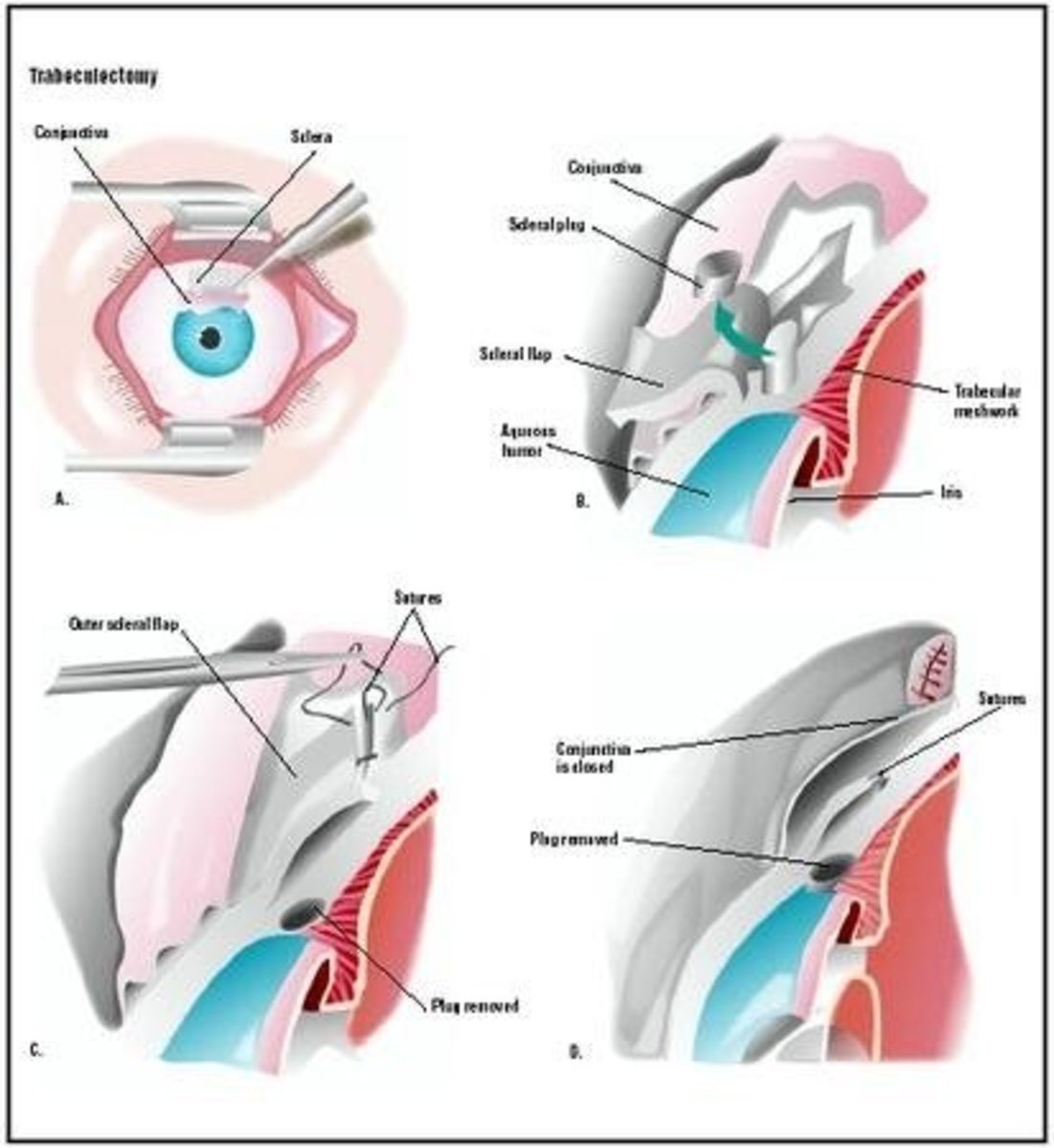 trabeculectomy