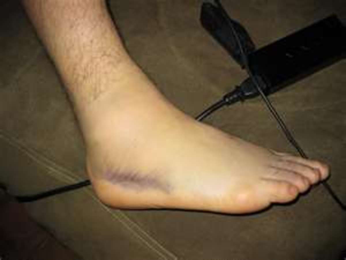 sprained-ankle-symptoms-and-how-to-heal-a-sprained-ankle