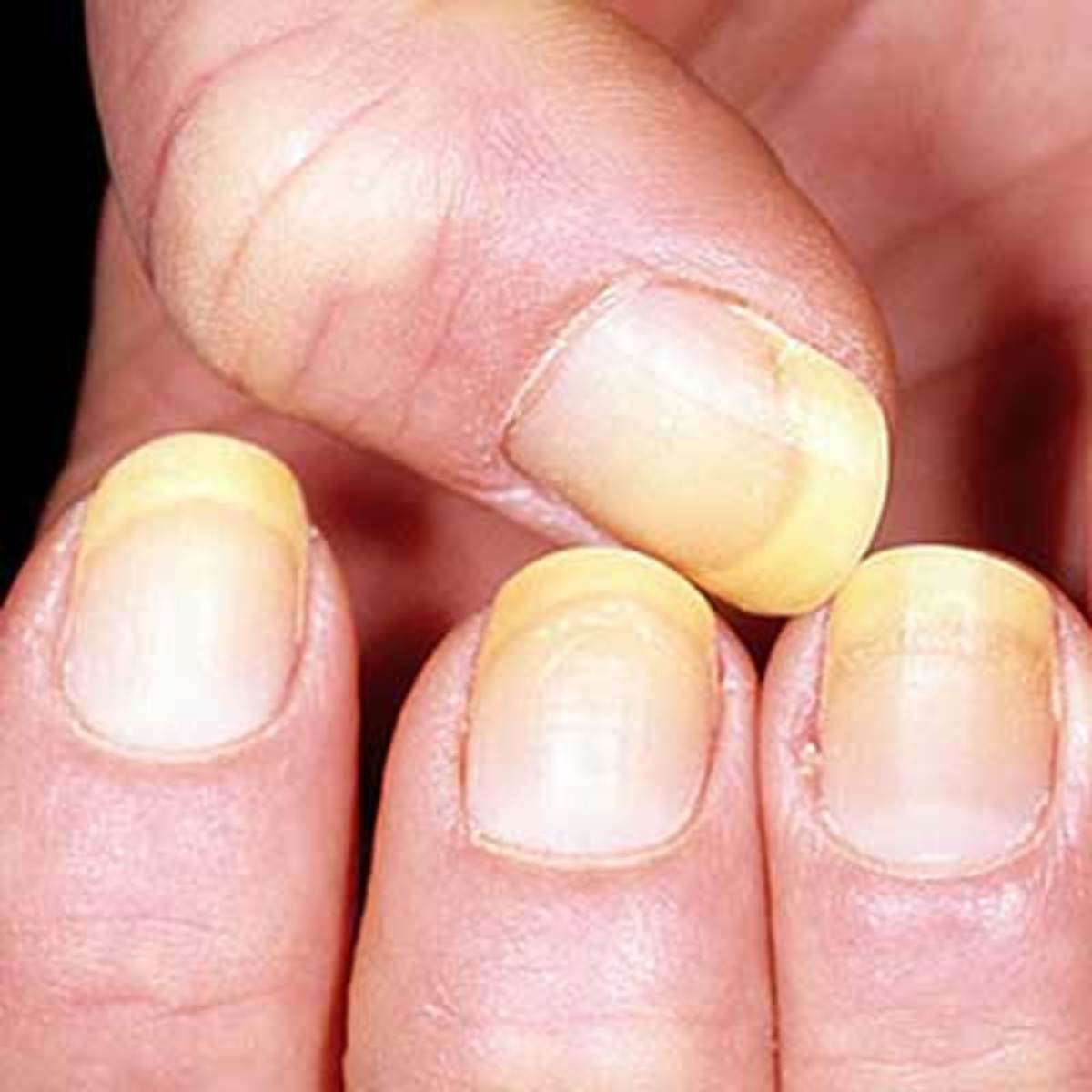 Длиныежелтые больные ногти
