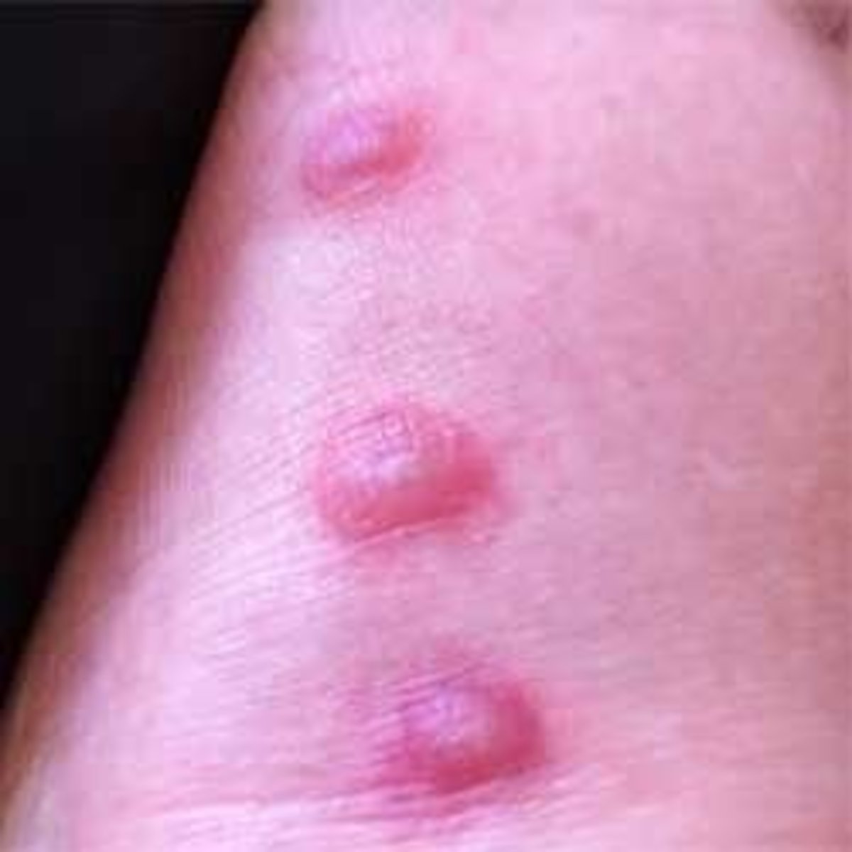 A picture of three Bullous Pemphigoid blisters
