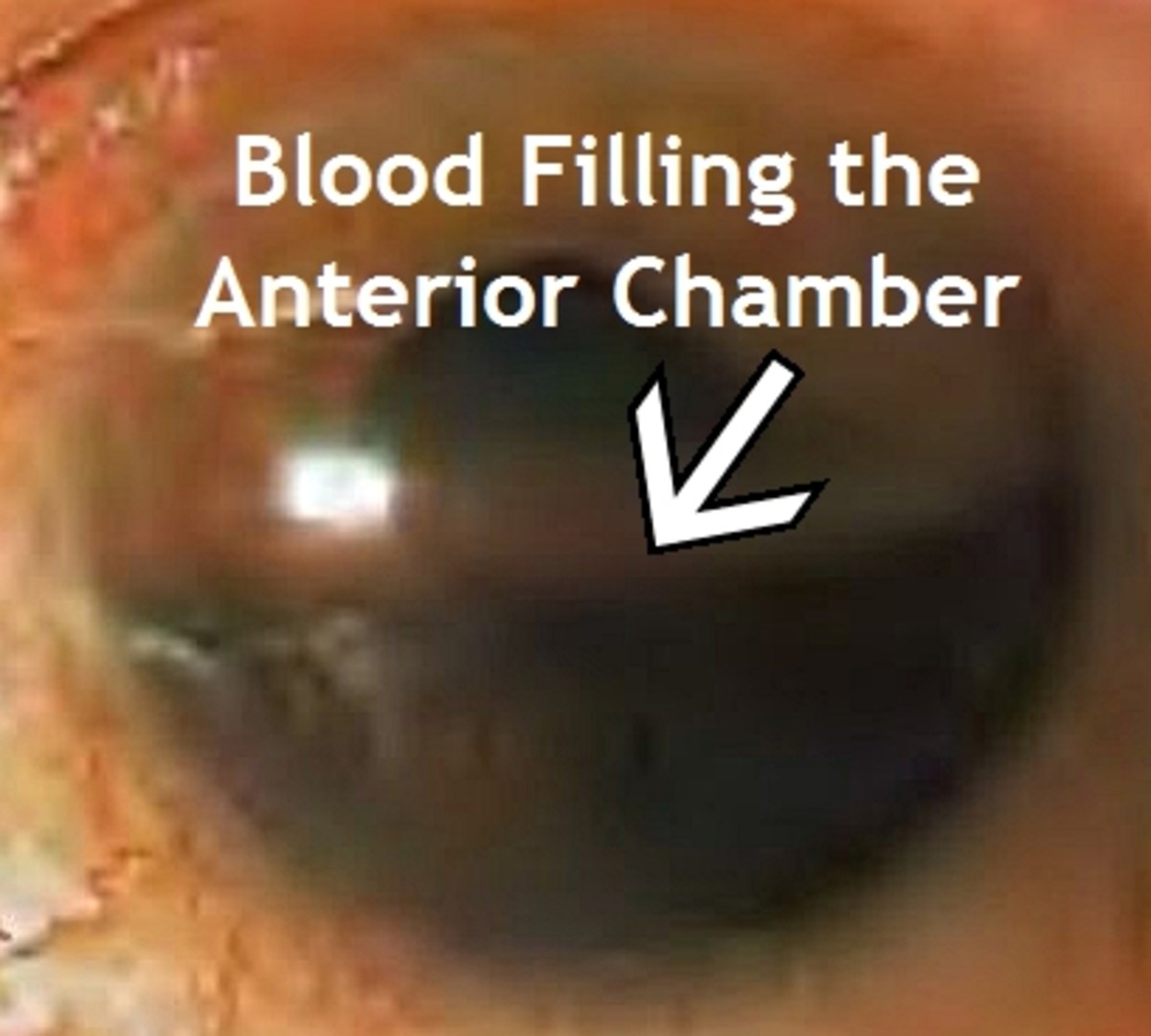 Hyphema, or blood in the lower half of the anterior chamber caused by a traumatic eye injury.