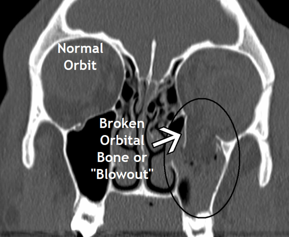 Image of an orbital blowout fracture. The fracture can be seen on the right-hand side of the image.