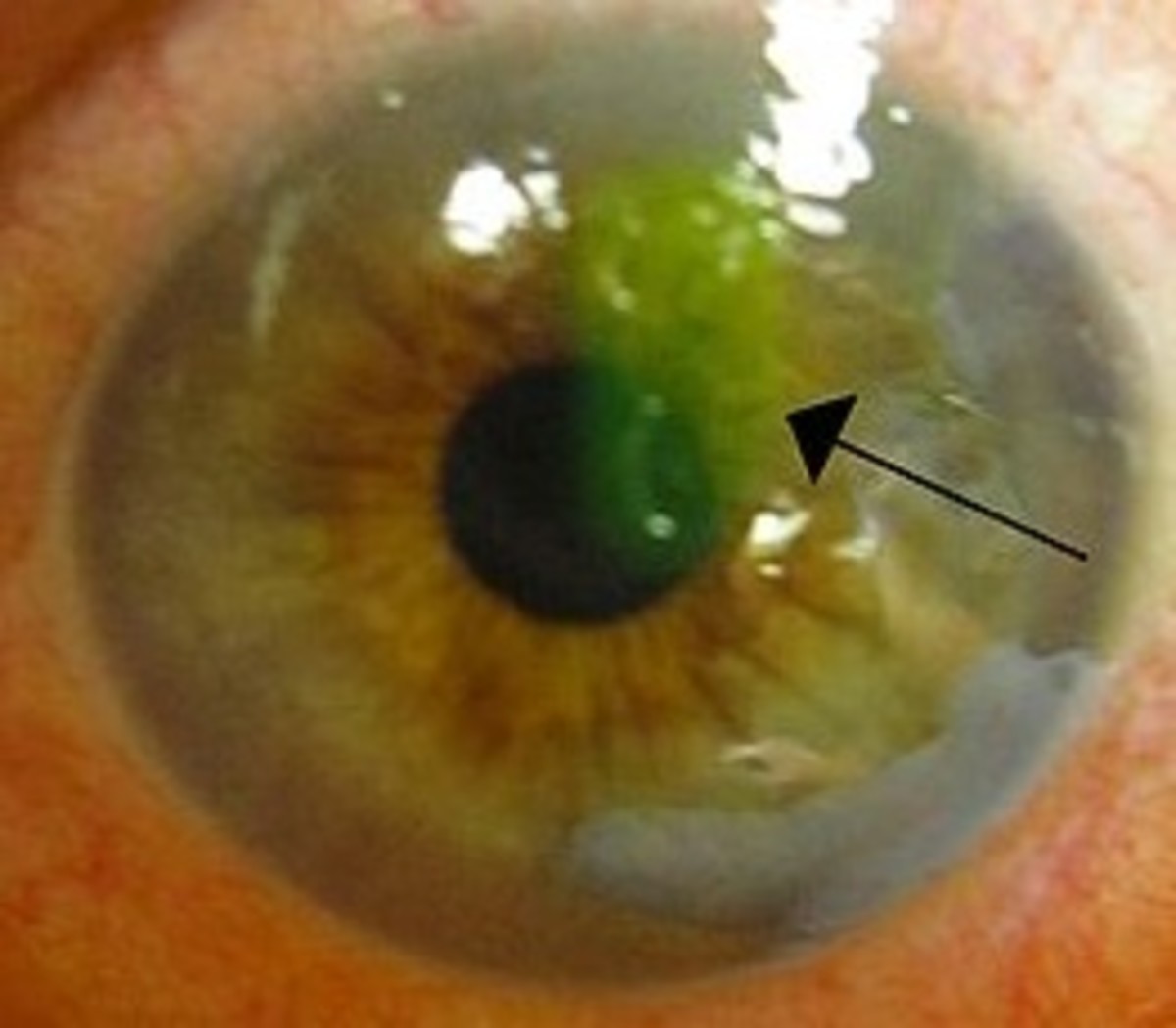 A large corneal abrasion, also called a scratched cornea.