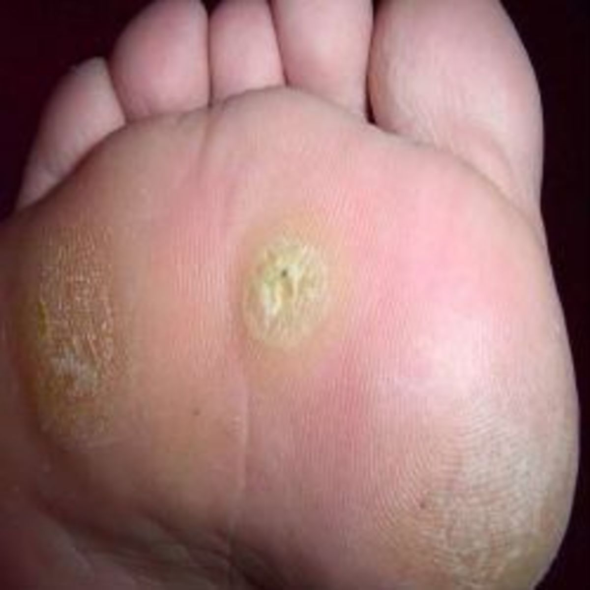 how-to-get-rid-of-plantar-warts-2