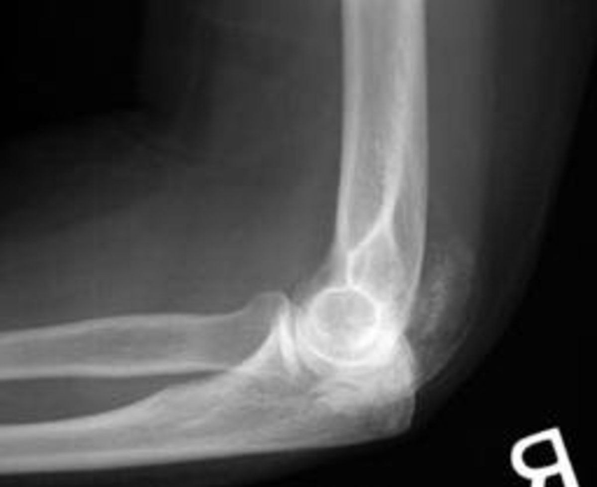 Myositis Ossificans - Elbow Joint - Physiotherapy Treatment - 1