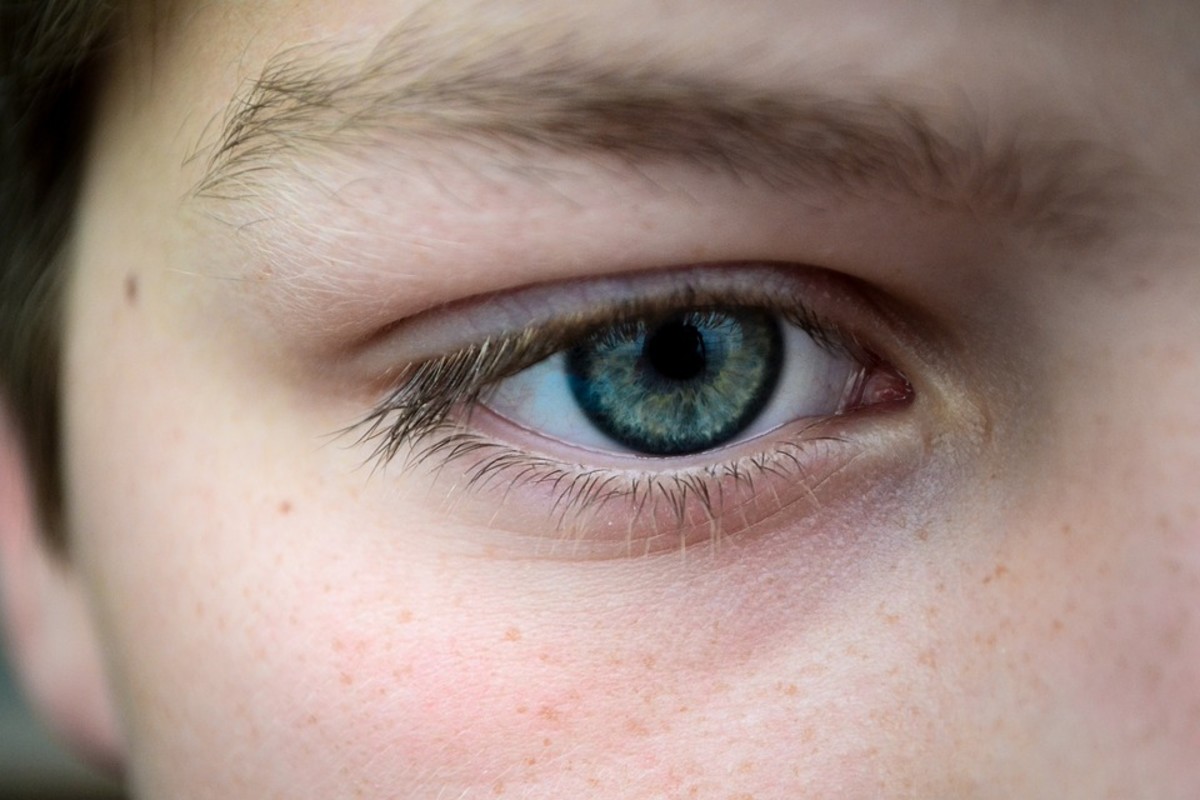Ocular Cicatricial Pemphigoid: Symptoms, Causes, Diagnosis, Treatment, Hypothesis and Progression