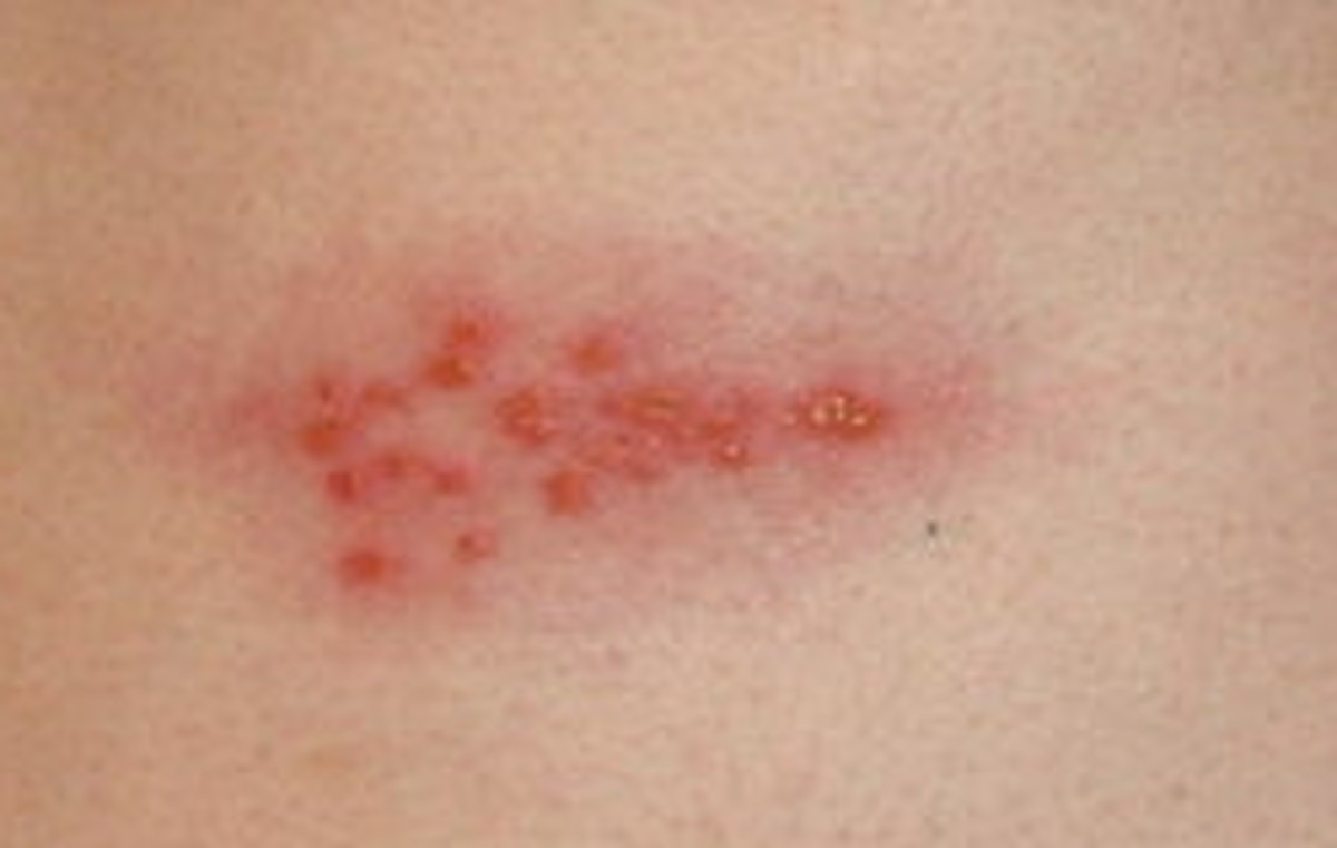 Self help with herpes (shingles, cold sores etc)