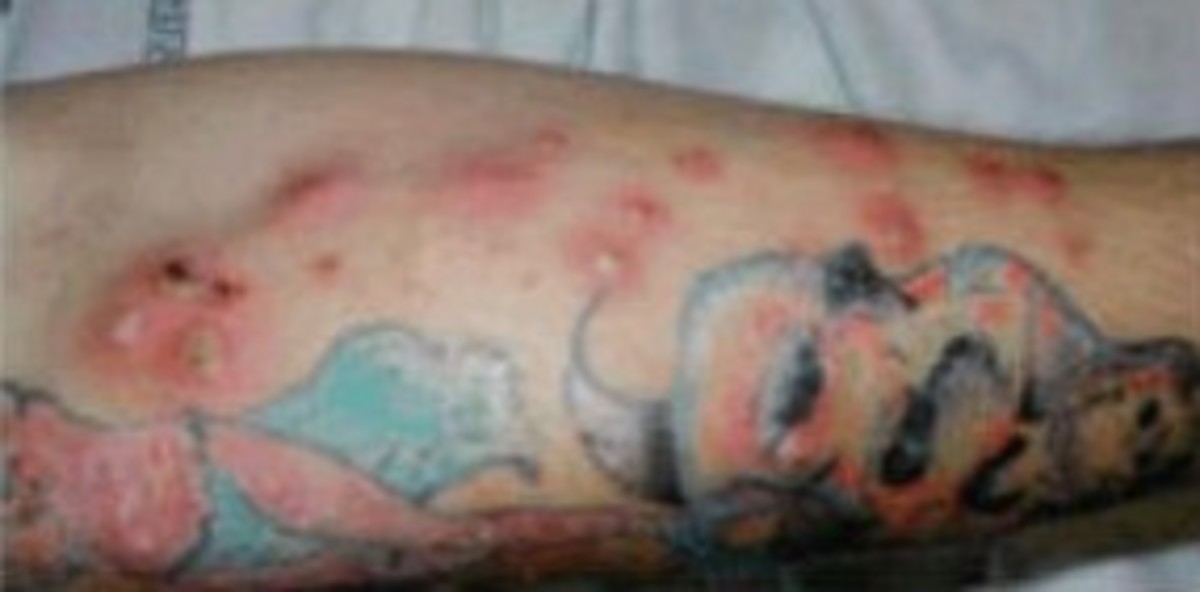 An arm tattoo with a staph infection. This tattoo infection can be serious and should be looked at by a doctor.
