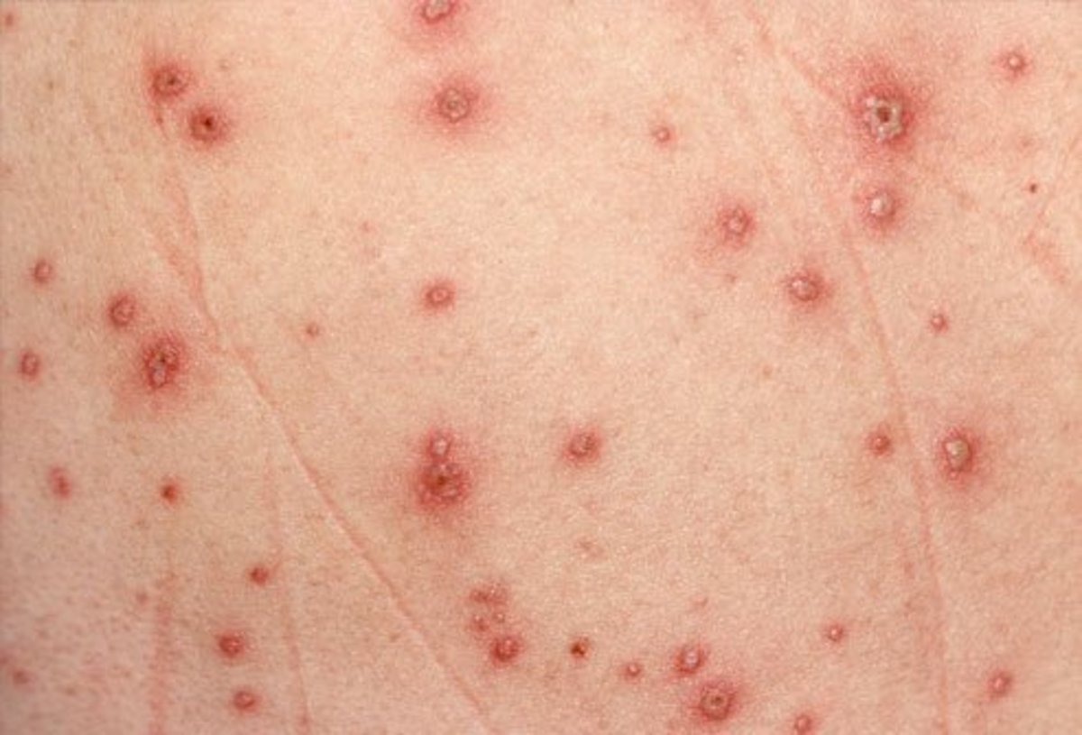 Kælder Alert Bibliografi Red Spots on Skin - HubPages