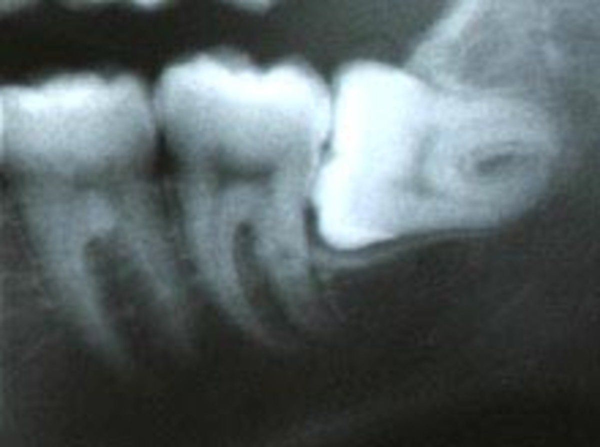 Кривой зуб мудрости рентген