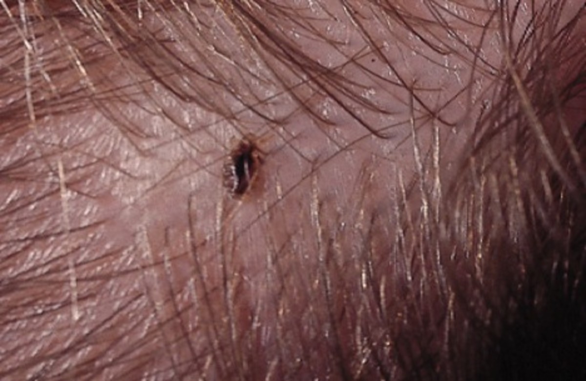 resurgence-of-head-lice-in-the-uk