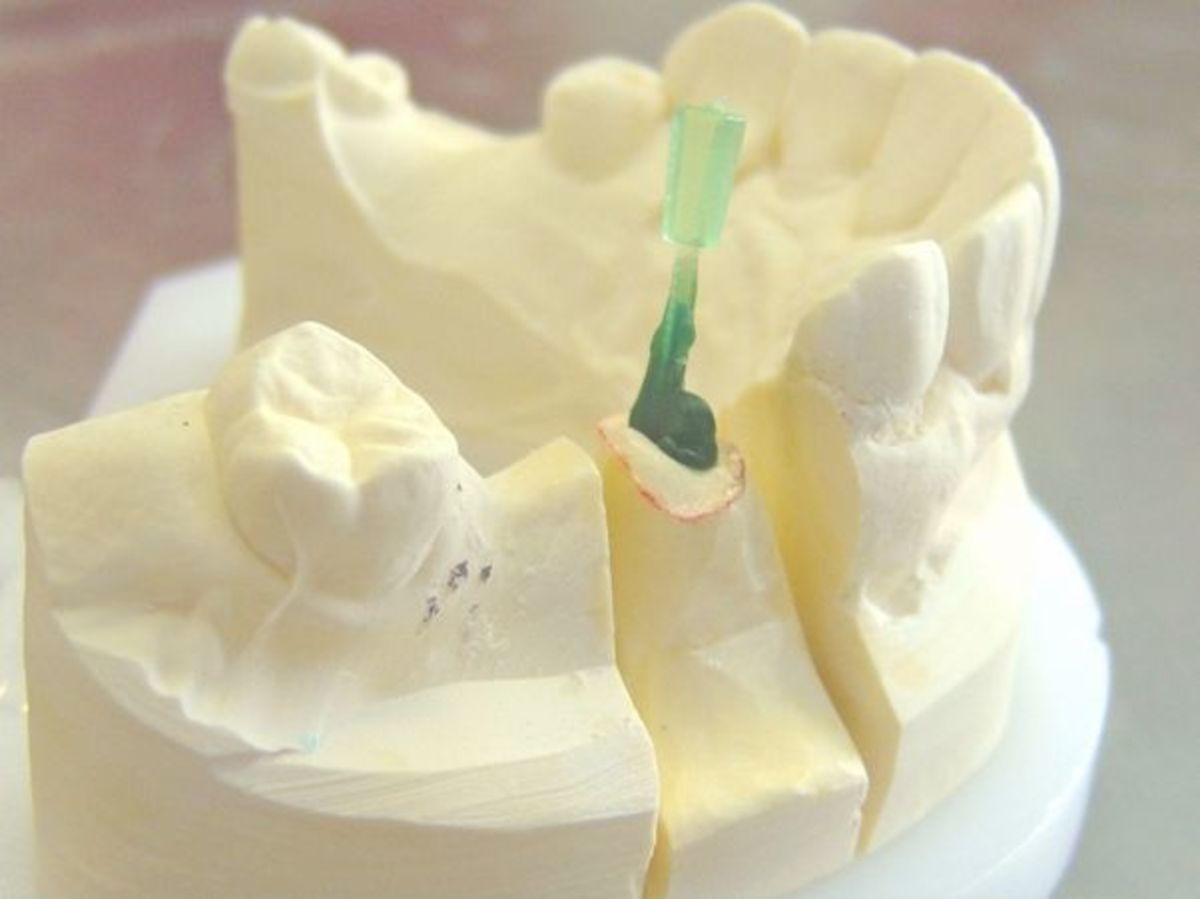 how-are-dental-pfm-crowns-made