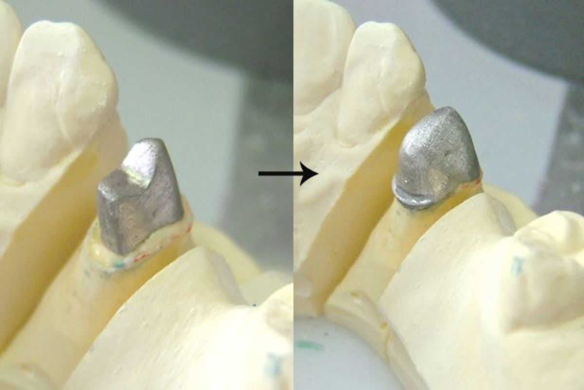 how-are-dental-pfm-crowns-made