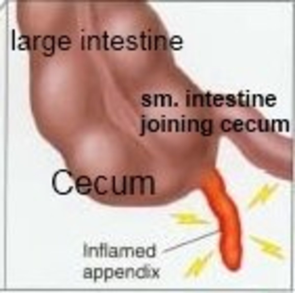 Inflamed appendix