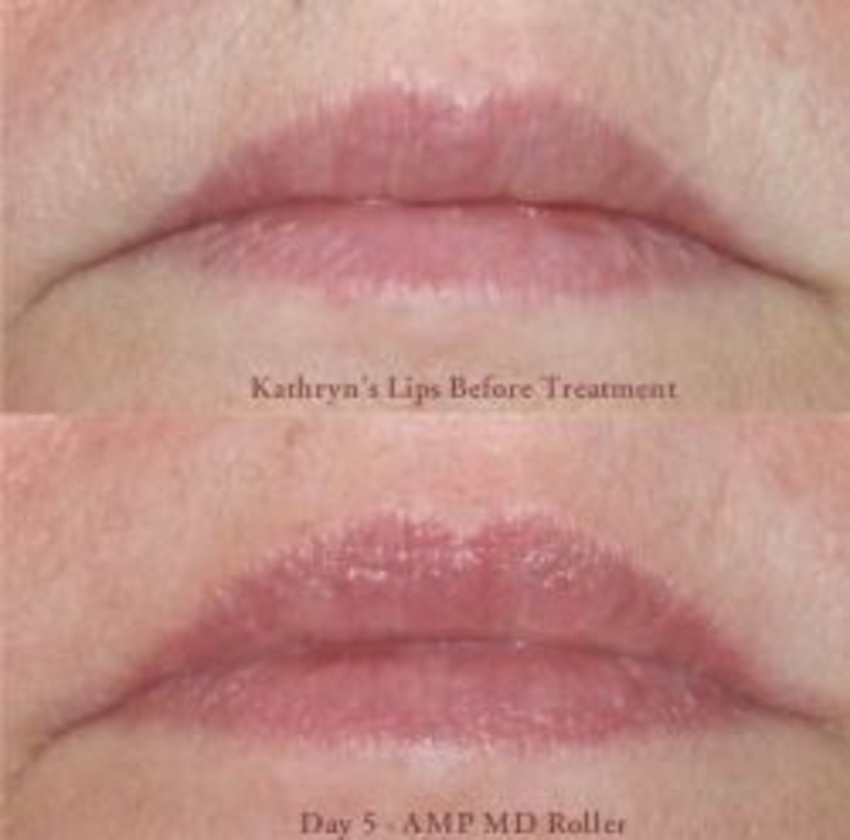 Kathryn's lips before & after