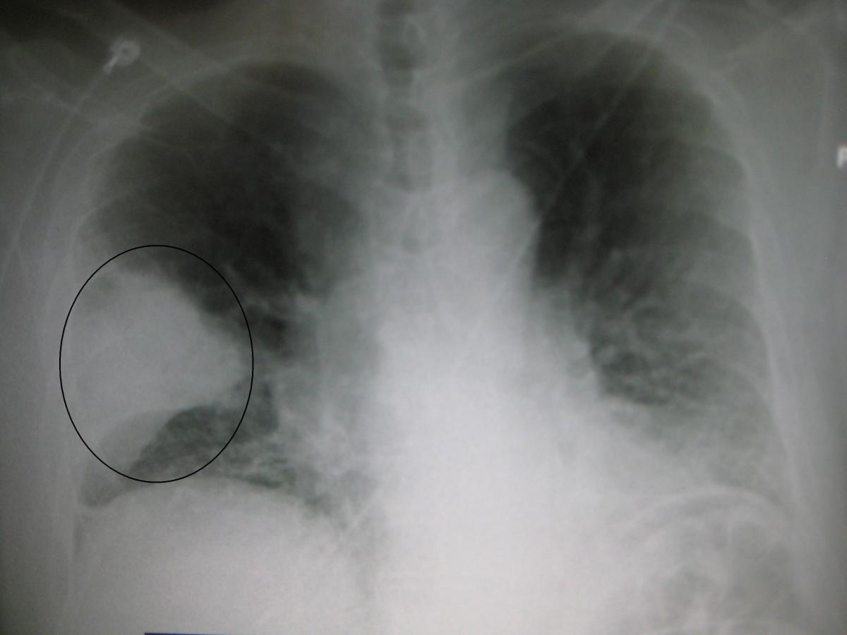 Enhancin is used commonly to treat Pneumonia 
