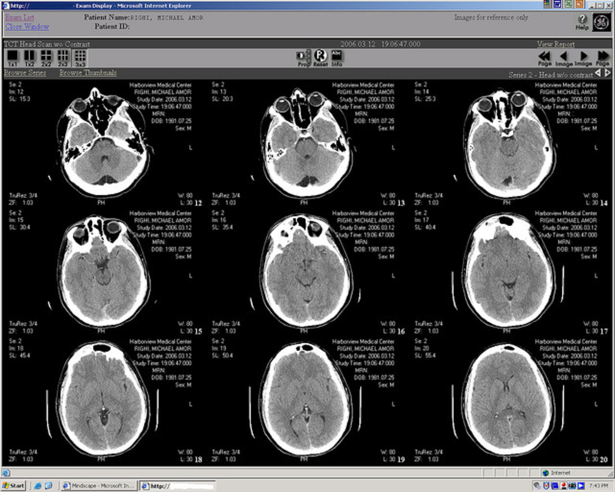 stroke- pictures of brain on mri