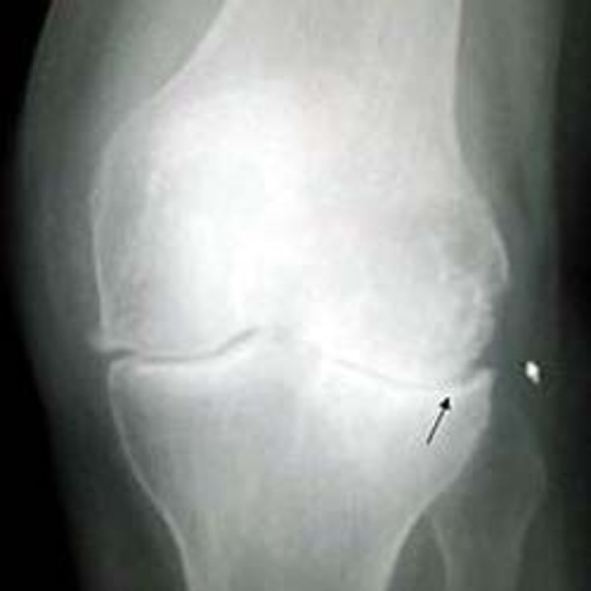 total-knee-replacement-surgery