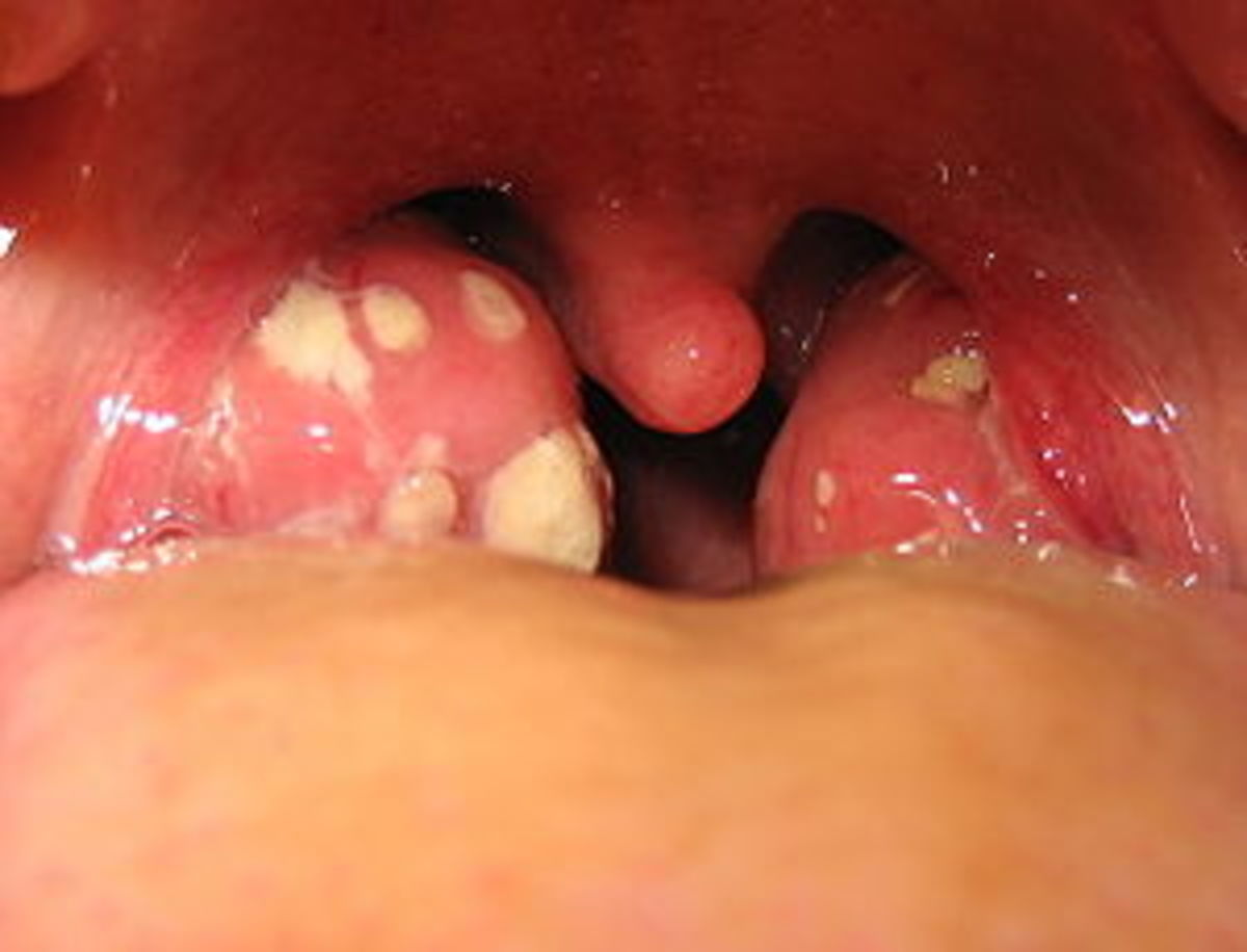 what-is-the-white-stuff-on-my-tonsils-tonsil-stones