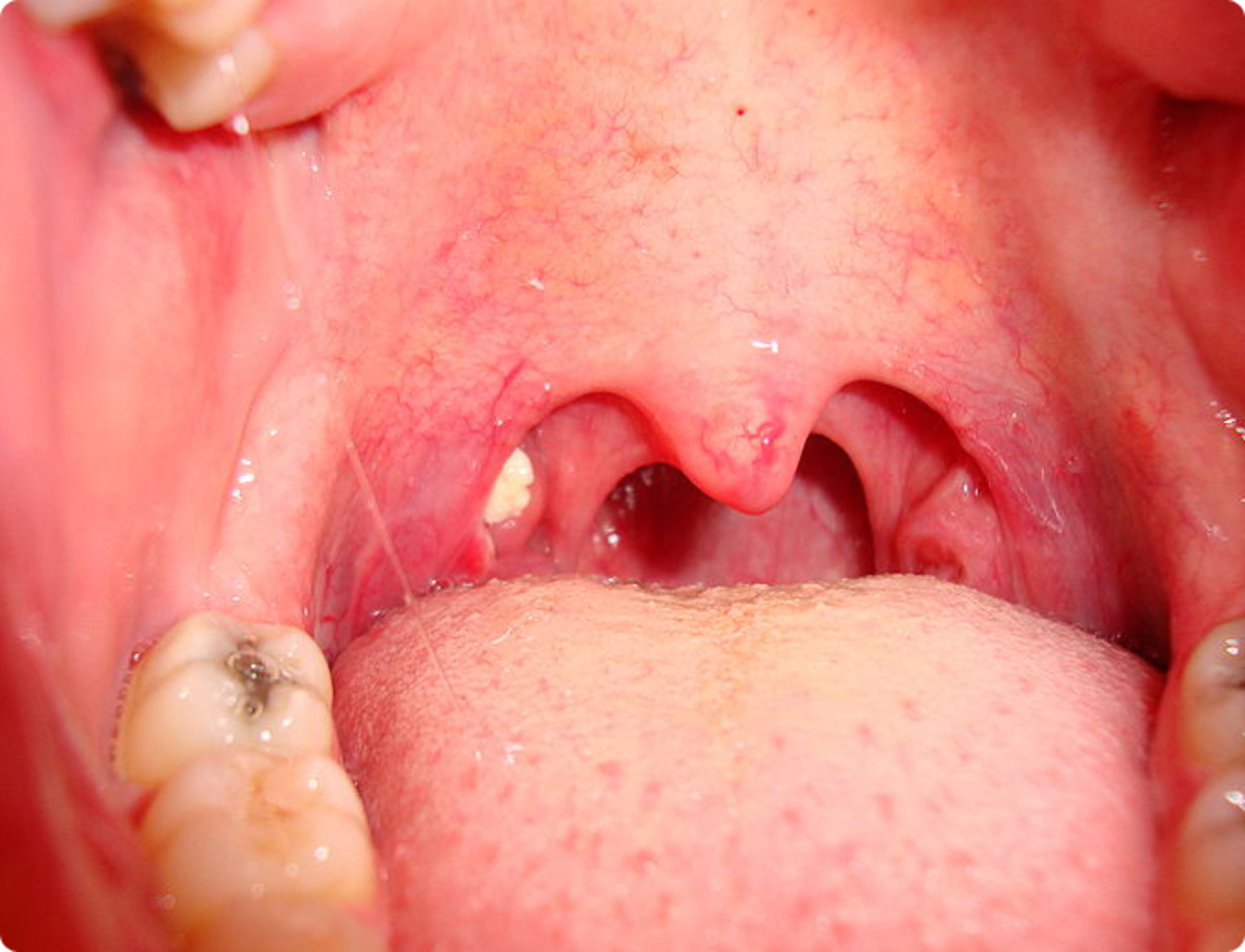 What Happens When You Have White Bumps in Your Throat?