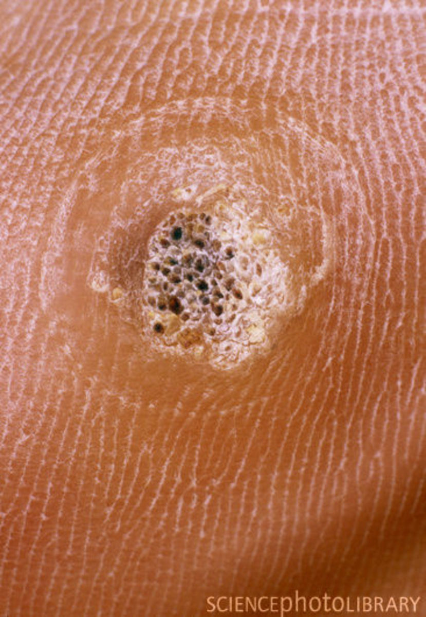 Verrucae and Warts - Rid yourself of this painful disfigurement with natural remedies.