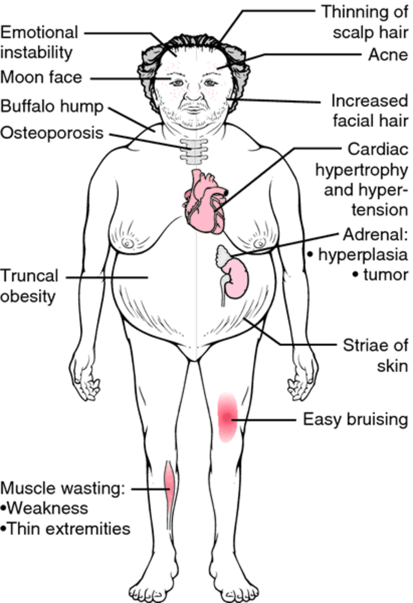 Cushing Syndrome Disease Causes And Treatment Hubpages 